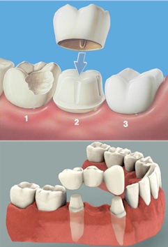 mock-ups of a crown and teeth bridge