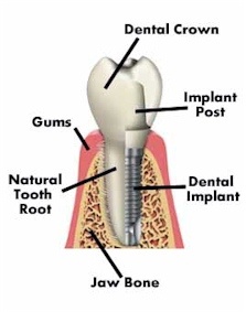 mock-up of a dental implant